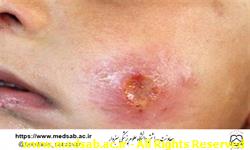 دانشگاه علوم پزشکی سبزوار، معاونت بهداشتی، بیماری سالک دانشگاه علوم پزشکی سبزوار، معاونت بهداشتی، بیماری سالک